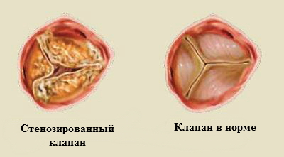 заболевания клапанов сердца